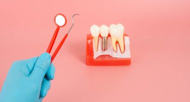 Diş implantlarından alınan örnekler diş implantlarının silikon bileşenlerini gösteriyor. Hastanın diş etlerine yerleştirildiğinde hastanın tedaviye başlamadan önce anlaması için..