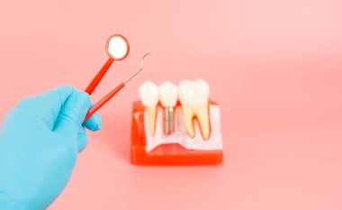 Diş implantlarından alınan örnekler diş implantlarının silikon bileşenlerini gösteriyor. Hastanın diş etlerine yerleştirildiğinde hastanın tedaviye başlamadan önce anlaması için..