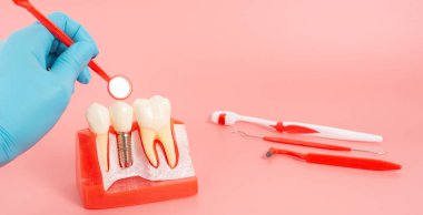 Diş implantlarından alınan örnekler diş implantlarının silikon bileşenlerini gösteriyor. Hastanın diş etlerine yerleştirildiğinde hastanın tedaviye başlamadan önce anlaması için..