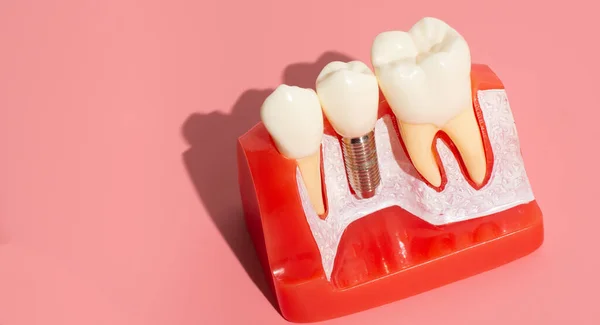 Examples of dental implants made from silicone demonstrate components of dental implants. When inserted into the patient\'s gums for the patient to understand before starting treatment.