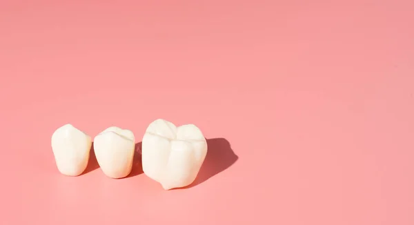 Exemplos Implantes Dentários Feitos Silicone Demonstram Componentes Implantes Dentários Quando — Fotografia de Stock