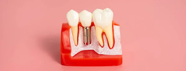 Examples of dental implants made from silicone demonstrate components of dental implants. When inserted into the patient\'s gums for the patient to understand before starting treatment.