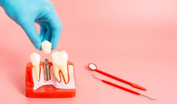 Examples of dental implants made from silicone demonstrate components of dental implants. When inserted into the patient\'s gums for the patient to understand before starting treatment.