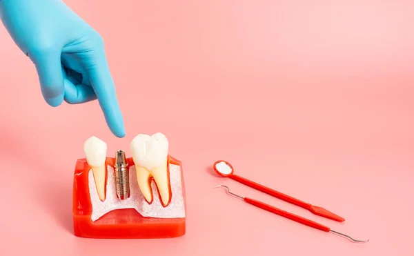 Diş implantlarından alınan örnekler diş implantlarının silikon bileşenlerini gösteriyor. Hastanın diş etlerine yerleştirildiğinde hastanın tedaviye başlamadan önce anlaması için..