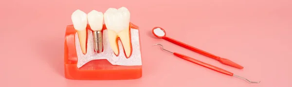 Examples of dental implants made from silicone demonstrate components of dental implants. When inserted into the patient\'s gums for the patient to understand before starting treatment.