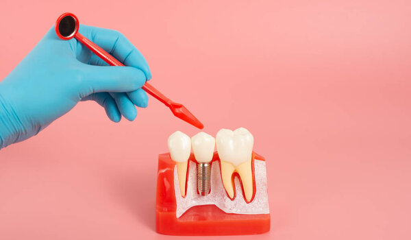Examples of dental implants made from silicone demonstrate components of dental implants. When inserted into the patient's gums for the patient to understand before starting treatment.