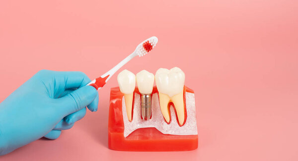 Examples of dental implants made from silicone demonstrate components of dental implants. When inserted into the patient's gums for the patient to understand before starting treatment.