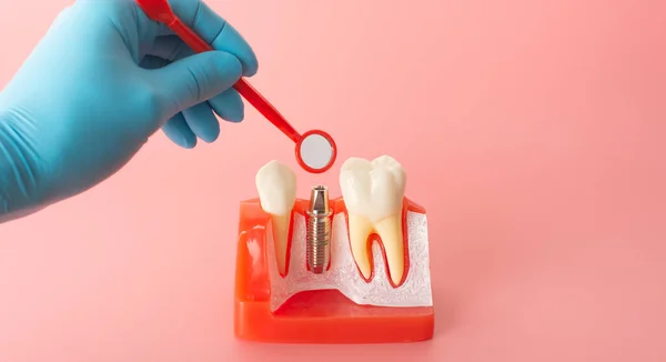 用硅胶制成的假牙植入物的例子表明了假牙植入物的成分 当植入病人的牙龈供病人在开始治疗前理解时 — 图库照片