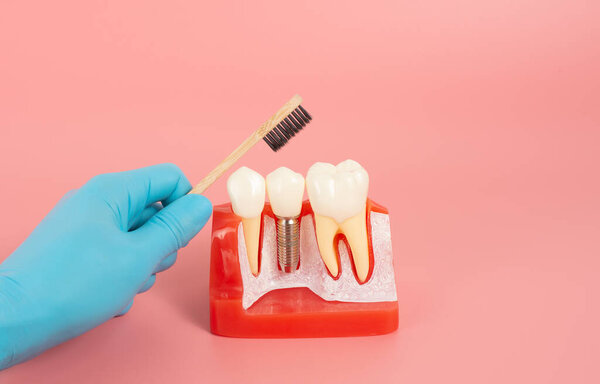 Examples of dental implants made from silicone demonstrate components of dental implants. When inserted into the patient's gums for the patient to understand before starting treatment.