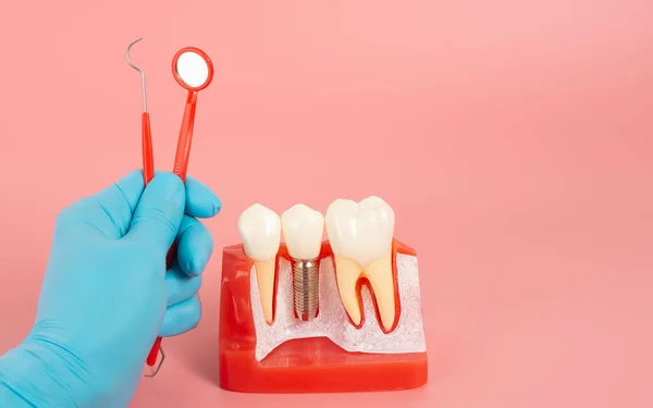 Examples of dental implants made from silicone demonstrate components of dental implants. When inserted into the patient's gums for the patient to understand before starting treatment.