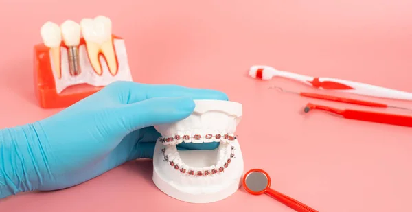 Examples of dental implants made from silicone demonstrate components of dental implants. When inserted into the patient\'s gums for the patient to understand before starting treatment.