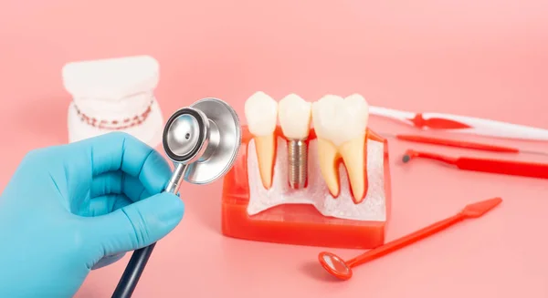 Ejemplos Implantes Dentales Hechos Silicona Demuestran Componentes Implantes Dentales Cuando — Foto de Stock