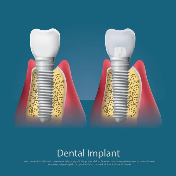 Dentes humanos e implante dentário Ilustração vetorial — Vetor de Stock
