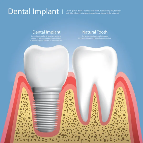 Vektorová ilustrace lidských zubů a zubních implantátů — Stockový vektor