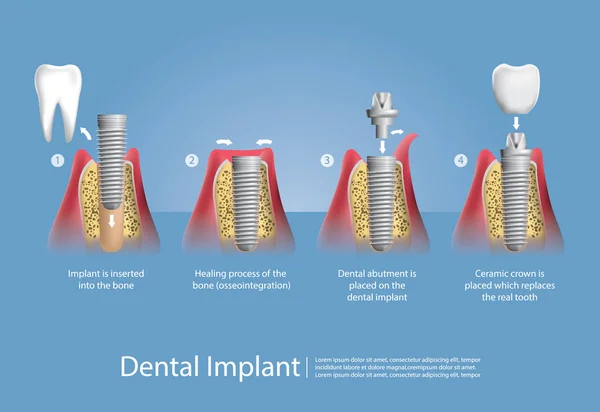 Vektorová ilustrace lidských zubů a zubních implantátů — Stockový vektor