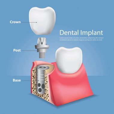 İnsan dişleri ve diş implantı Vektör İllüstrasyonu