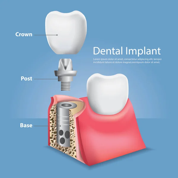 Dents humaines et implant dentaire Illustration vectorielle — Image vectorielle