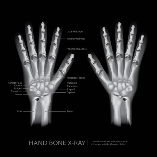 Ilustración del vector de rayos X del hueso de la mano — Vector de stock