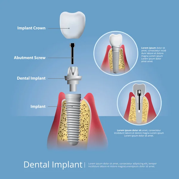 Зуби людини та стоматологічна імплантація Векторні ілюстрації — стоковий вектор