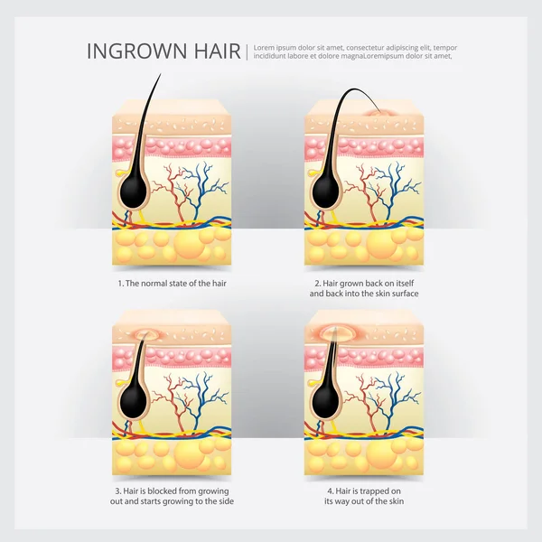 Ingrown struttura dei capelli vettoriale illustrazione — Vettoriale Stock