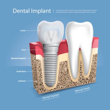 İnsan dişleri ve diş implantı Vektör İllüstrasyonu