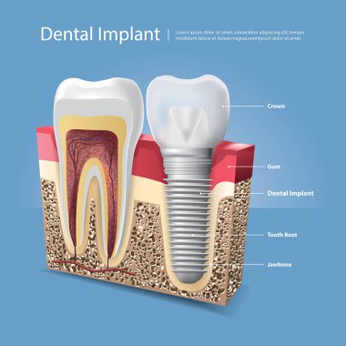İnsan dişleri ve diş implantı Vektör İllüstrasyonu