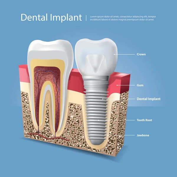 Dentes humanos e implante dentário Ilustração vetorial — Vetor de Stock