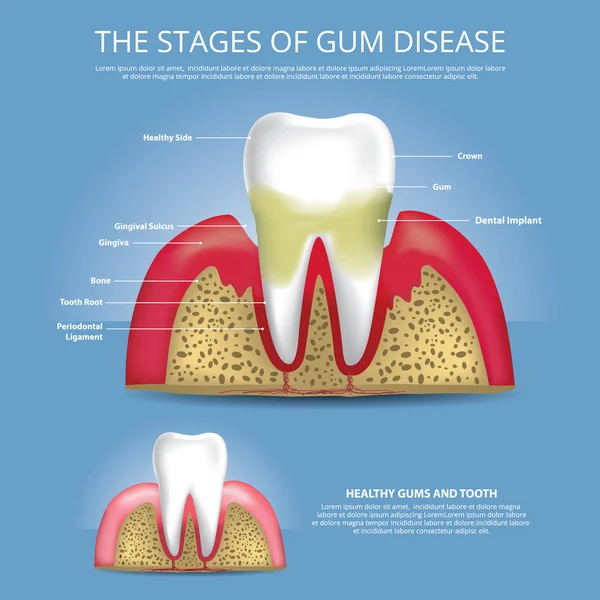 Dientes humanos Etapas de la enfermedad de las encías Vector Ilustración — Vector de stock