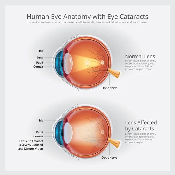 Cataractes Trouble de la vision et anatomie normale de la vision des yeux Illustration vectorielle — Image vectorielle