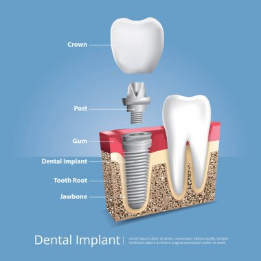 İnsan dişleri ve diş implantı Vektör İllüstrasyonu