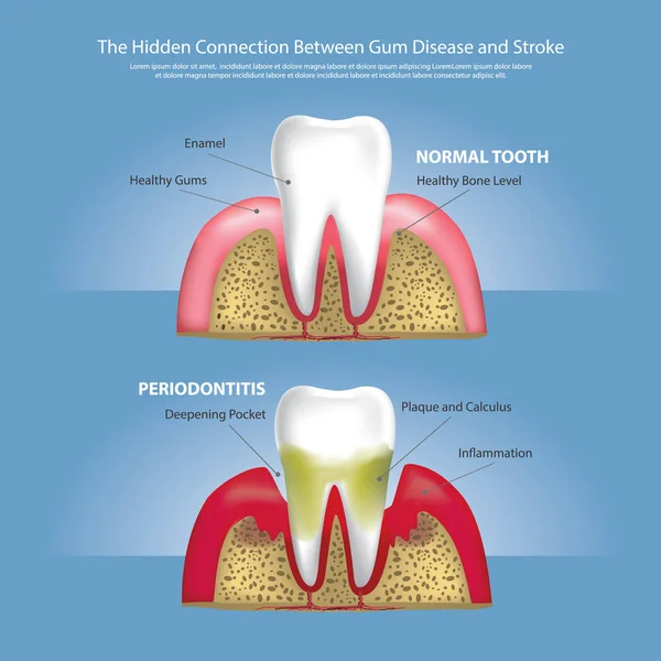 Hidden Connection Gum Disease Stroke Vector Illustration — Stock Vector