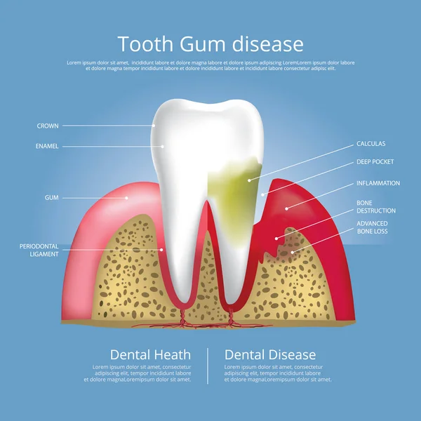 Denti Umani Fasi Della Malattia Gengivale Illustrazione Vettoriale — Vettoriale Stock