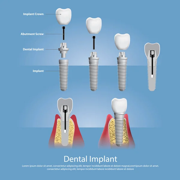 Menschliche Zähne Und Zahnimplantate Vektor Illustration — Stockvektor