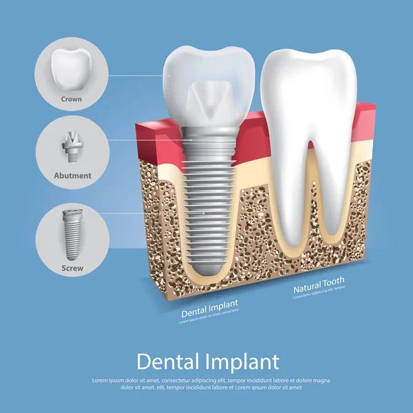 Ludzkie Zęby Implant Dentystyczny Ilustracja Wektora — Wektor stockowy