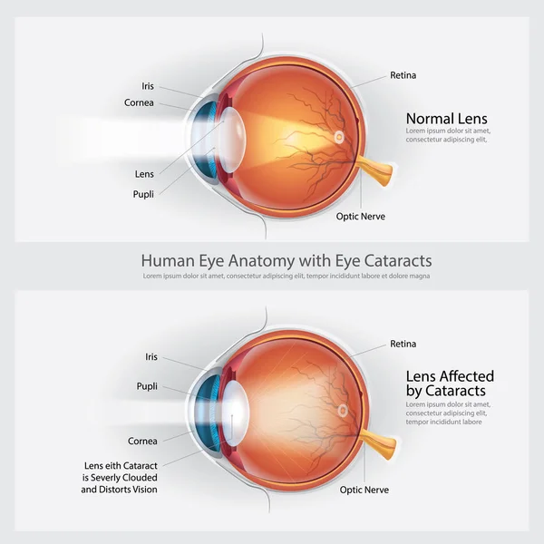 Cataractes Trouble Vision Anatomie Normale Vision Des Yeux Illustration Vectorielle — Image vectorielle