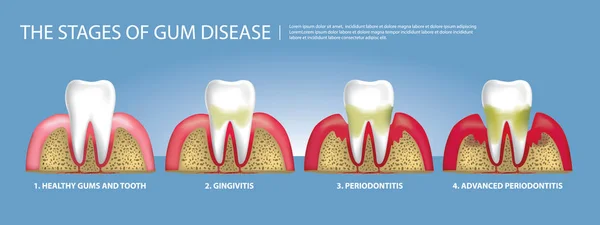 Dientes Humanos Etapas Enfermedad Las Encías Vector Ilustración — Vector de stock