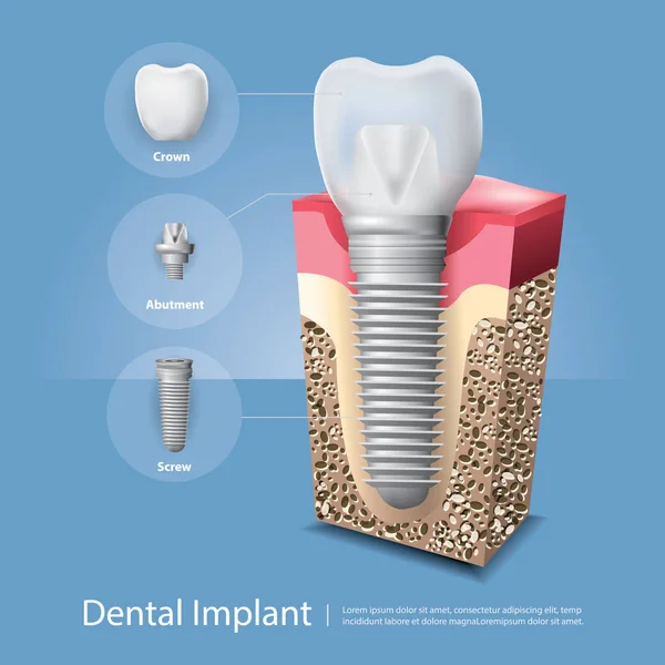 İnsan dişleri ve diş implantı Vektör İllüstrasyonu