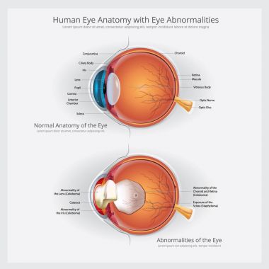 Göz anatomisi göz anormallikleri vektör çizim ile