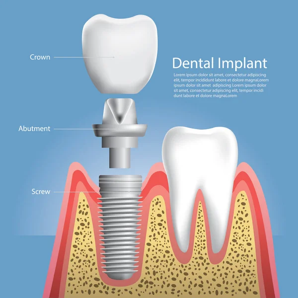 İnsan dişleri ve diş implantı Vektör İllüstrasyonu