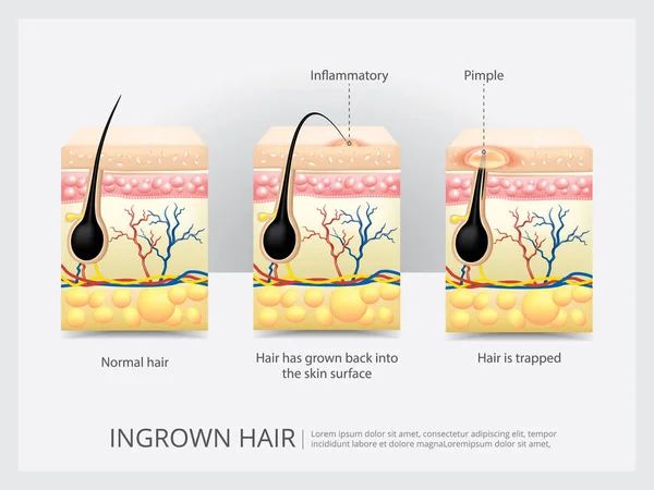 Ingrown Hair Structure Vector Illustration — Stock Vector