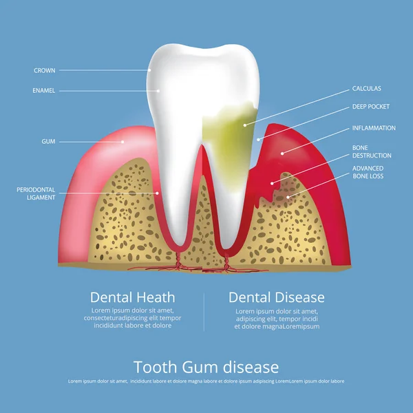 Denti Umani Fasi Della Malattia Gengivale Illustrazione Vettoriale — Vettoriale Stock