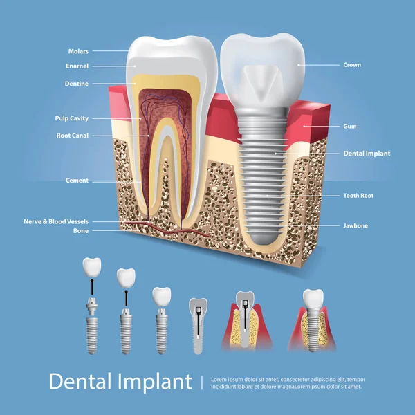 İnsan dişleri ve diş implantı Vektör İllüstrasyonu