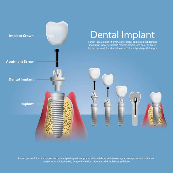 İnsan dişleri ve diş implantı Vektör İllüstrasyonu
