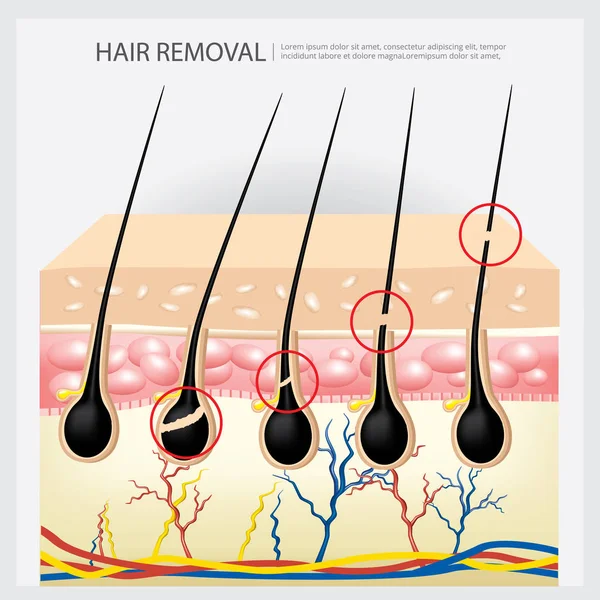 Hair Removal Example Vector Illustration — Stock Vector