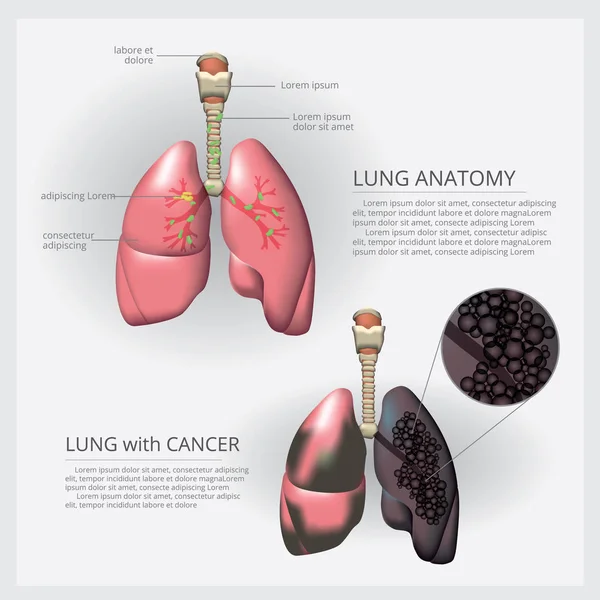 Illustration Détaillée Vectorielle Cancer Poumon — Image vectorielle