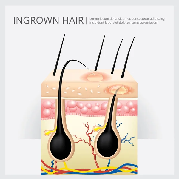 Eingewachsene Haarstruktur Vektor Illustration — Stockvektor