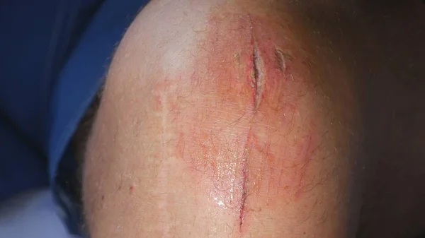 Immagine con una gamba ferita una cicatrice sanguinante un graffio doloroso da un incidente, un uomo che soffre in attesa in ospedale infermieristica di emergenza — Foto Stock