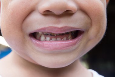 Asyalı çocuk gülümseme çürük diş ile