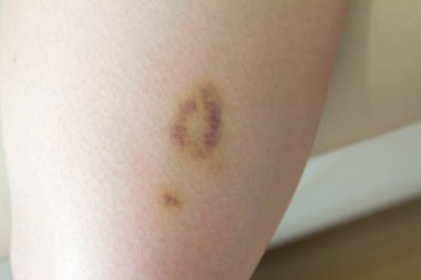 Closeup yara yara kadın bacak cilt