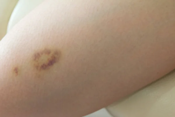 Closeup Hematomas na pele da perna da mulher ferida — Fotografia de Stock